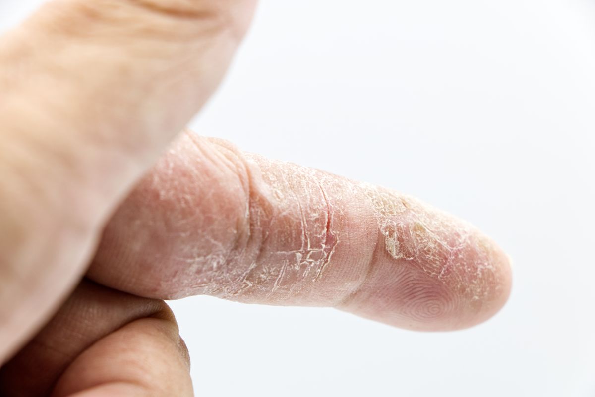 Close-up of cracked dry skin on a finger, the symptom often linked to hard water dry skin complaints